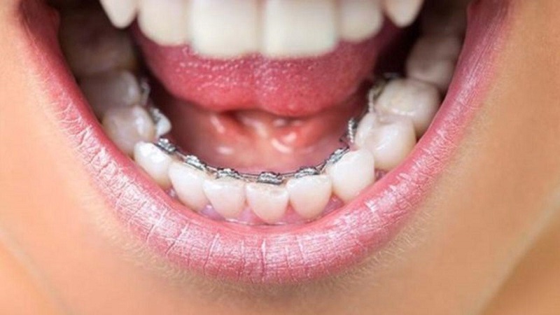 Niềng răng mặt lưỡi cũng đảm bảo tính thẩm mỹ rất nhiều