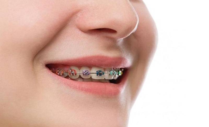 Niềng răng móm sẽ dịch chuyển răng về vị trí đúng trên hàm