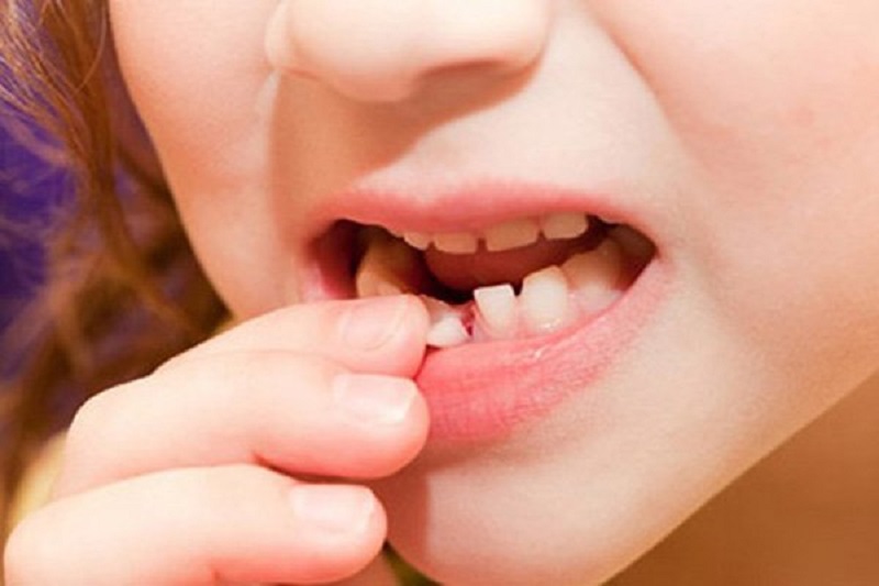 Răng trẻ mọc lẫy sẽ xuất hiện phổ biến ở trẻ từ 5 đến 7 tuổi