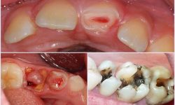 Tìm hiểu nguyên nhân, mức độ sâu răng hàm và các phương pháp chữa trị tại nhà