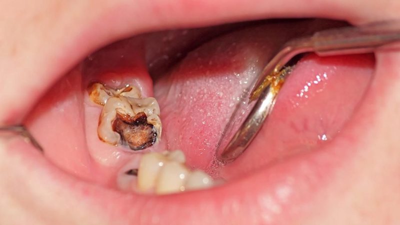Khi răng sâu không thể phục hồi, người bệnh bắt buộc phải nhổ răng.