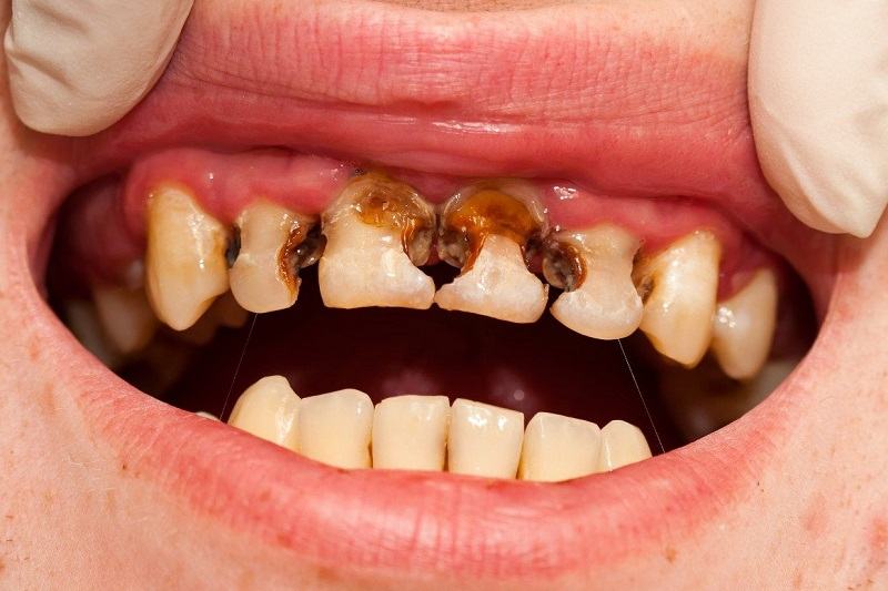 Tình trạng sún răng gặp ở nhiều người