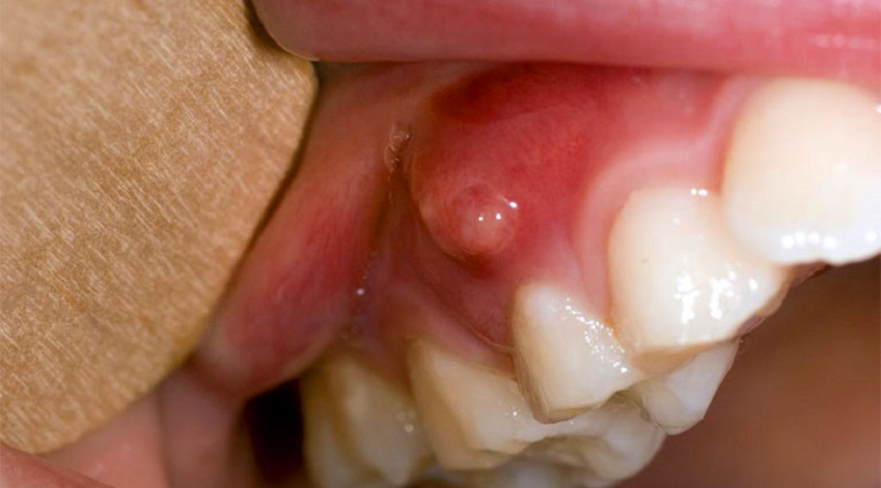 Áp xe răng được hiểu là bệnh do vệ sinh răng miệng không đúng cách gây ra