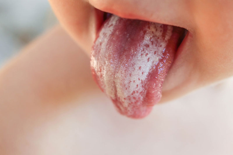 Tưa lưỡi là bệnh lý thường gặp ở trẻ sơ sinh và trẻ nhỏ