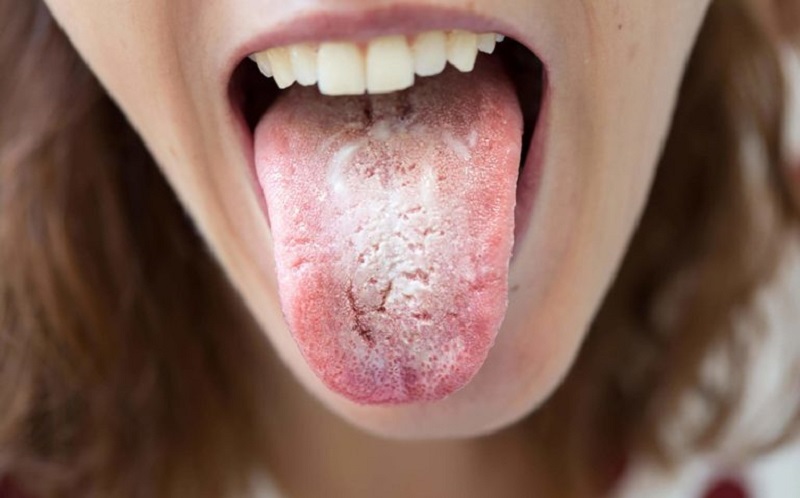 Tưa miệng khi mang thai có thể ảnh hưởng đến sức khỏe thai nhi