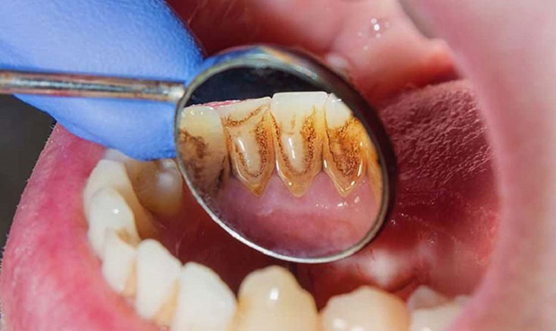 Vệ sinh răng miệng không đúng cách làm tăng nguy cơ viêm nha chu cấp
