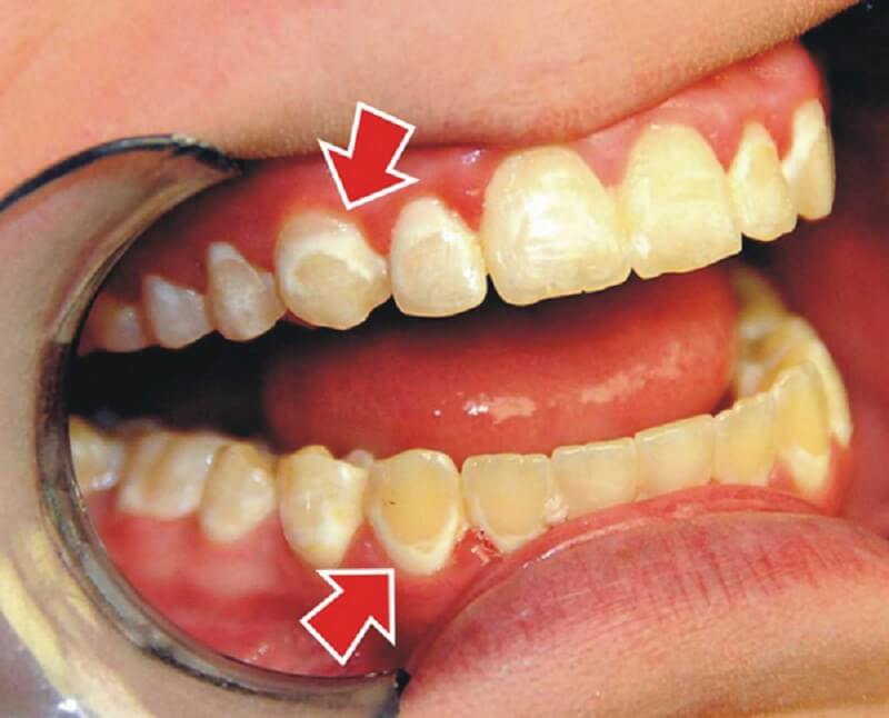 Viêm nha chu là hiện tượng vi khuẩn xâm nhập vào bên trong khoang miệng