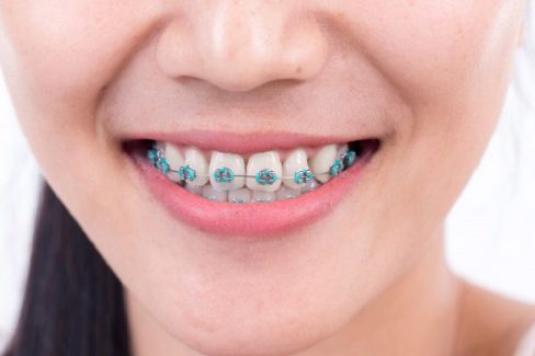 Truy tìm nguyên nhân viêm nha chu khi niềng răng