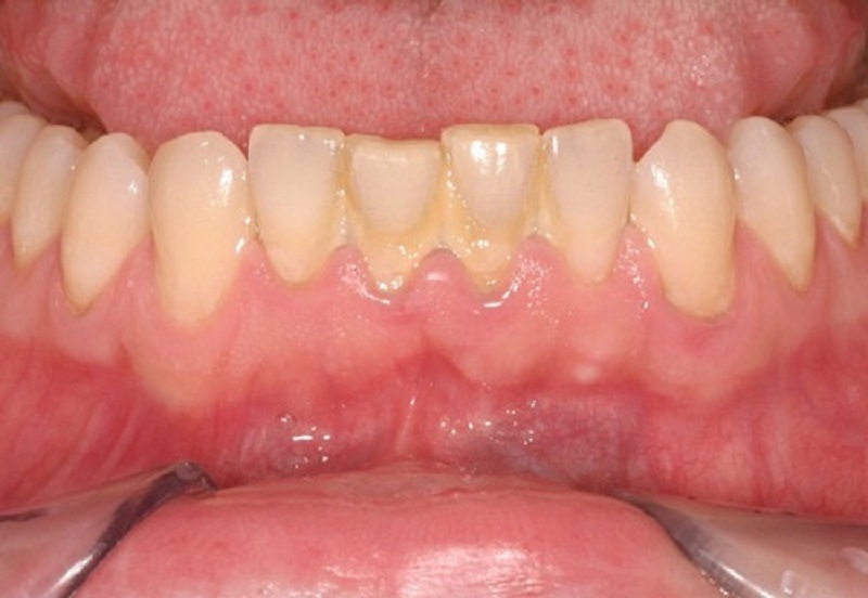 Người bị viêm nha chu có niềng răng được hay không?