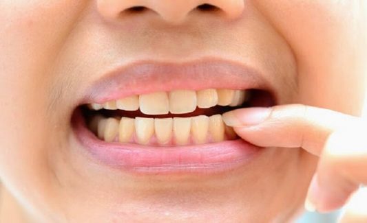 Viêm nha chu mãn tính là hiện tượng những mô nha chu đã bị viêm nhiễm rất nặng