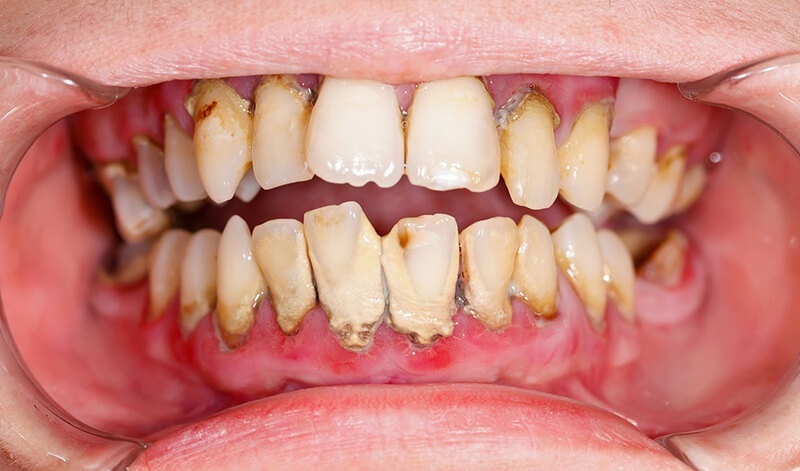 Viêm nướu răng có thể gây ra các biến chứng nguy hiểm