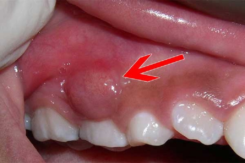Nguyên nhân đắng miệng hôi miệng do bị áp xe răng