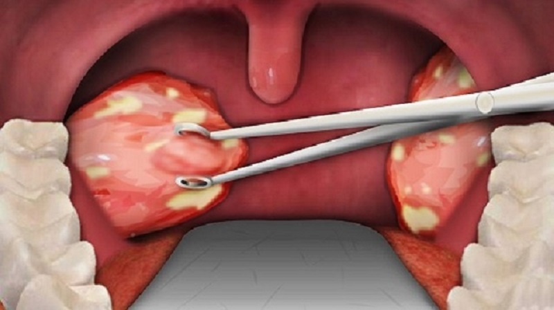 Một số loại ký sinh trùng là nguyên nhân gián tiếp dẫn tới hôi miệng