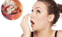 Khi răng bị sâu, vi khuẩn sẽ xâm nhập và làm cấu trúc răng bị ảnh hưởng
