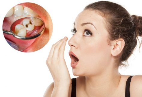Khi răng bị sâu, vi khuẩn sẽ xâm nhập và làm cấu trúc răng bị ảnh hưởng