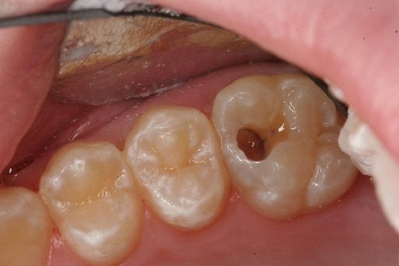 Sâu răng bị hôi miệng thường khá dễ nhận biết