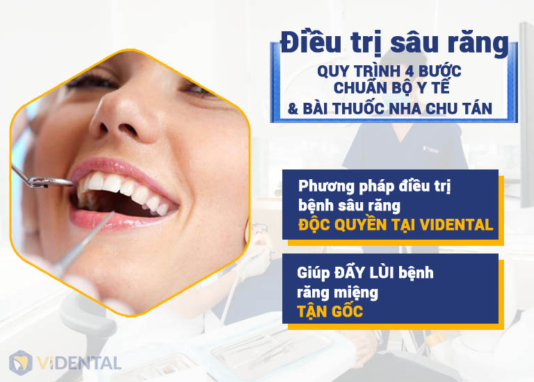 Phương pháp điều trị sâu răng độc quyền tại ViDental