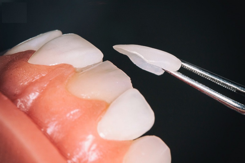 Dán sứ lên răng giúp răng trở nên đều đẹp và trắng sáng hơn