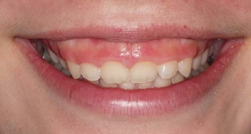 Người có chân răng ngắn nên khắc phục bằng cách dán sứ mặt răng