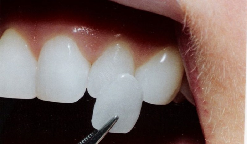 Bước dán sứ cho răng cần thực hiện tỉ mỉ, chuẩn xác mới đảm bảo tính thẩm mỹ