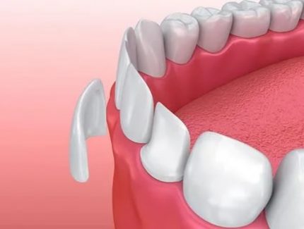 Dán sứ Veneer có tốt không phụ thuộc rất nhiều vào tay nghề của bác sĩ thực hiện