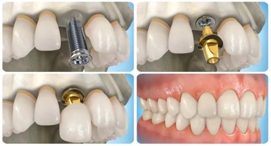 Có rất nhiều yếu tố ảnh hưởng đến giá trồng răng