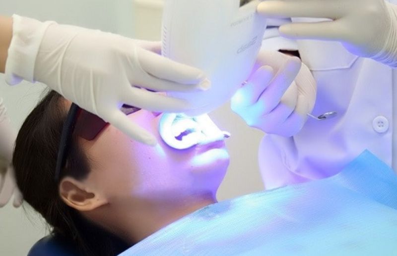 Tẩy trắng răng tại nha khoa đem lại hiệu quả tức thì