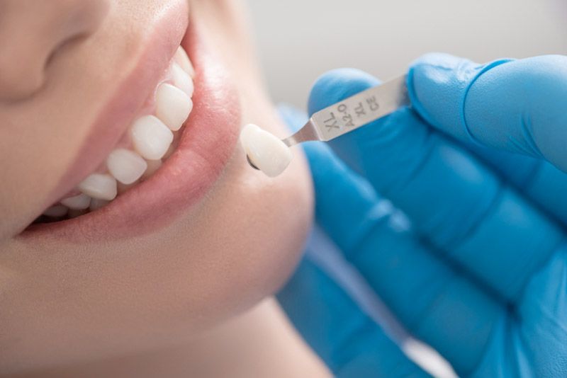 Hỏi ý kiến bác sĩ nha khoa để biết lựa chọn sản phẩm dùng dán răng sứ tốt nhất