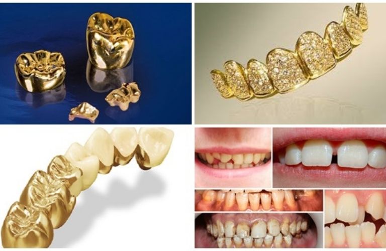 Nguyên liệu vàng được sử dụng trong nghiên cứu và chế tác tại ViDental.