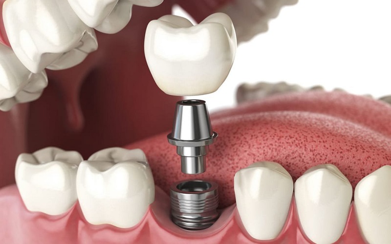 Trồng răng Implant là hình thức nổi bật của Nha khoa Lê Thành Tâm