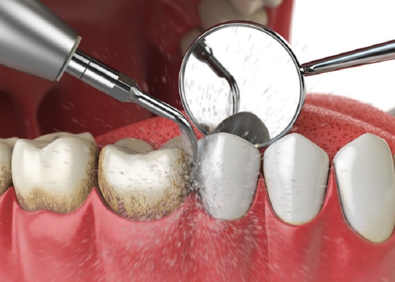 Cạo vôi răng là loại hình dịch vụ phòng khoa phổ biến tại nha khoa Gia Định