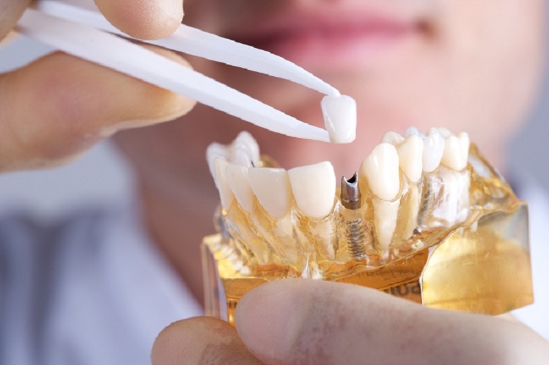 Trồng răng là phương pháp phục hình răng đã mất vô cùng hiệu quả