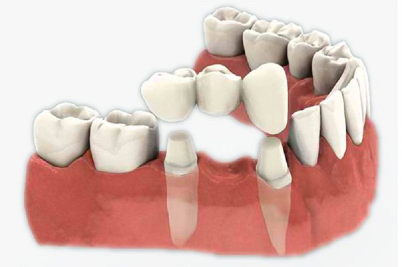 Phương pháp cầu răng sứ đảm bảo chức ăn nhai một cách tối đa