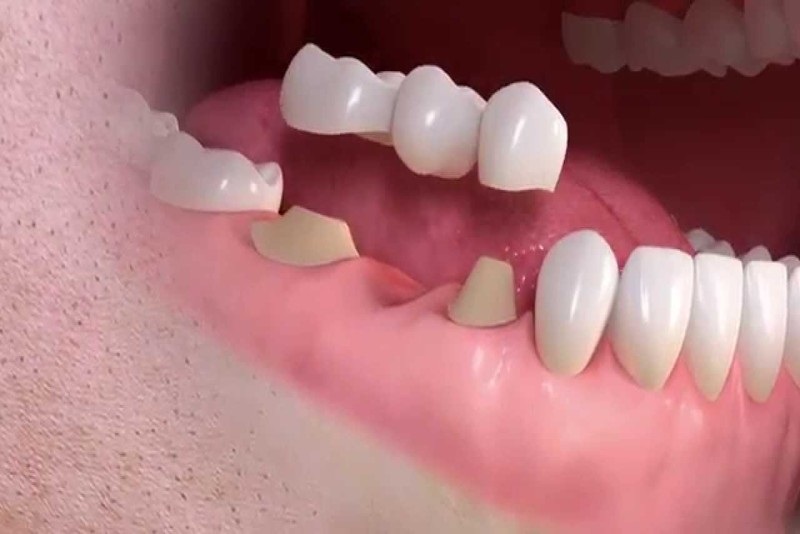 Khi thực hiện cầu răng sứ, hai răng bên cạnh chiếc răng đã mất sẽ cần mài mòn