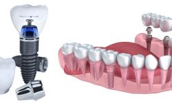 Trồng răng sứ cố định duy trì trọn đời trong khoang miệng mà không cần phải phục hình lại