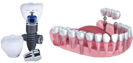 Trồng răng sứ cố định duy trì trọn đời trong khoang miệng mà không cần phải phục hình lại