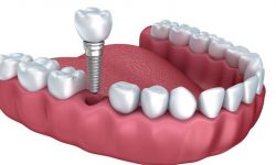 Trồng răng giả có ảnh hưởng gì không sẽ phụ thuộc vào quy trình thực hiện của bác sĩ