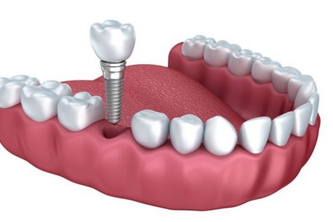 Trồng răng giả có ảnh hưởng gì không sẽ phụ thuộc vào quy trình thực hiện của bác sĩ