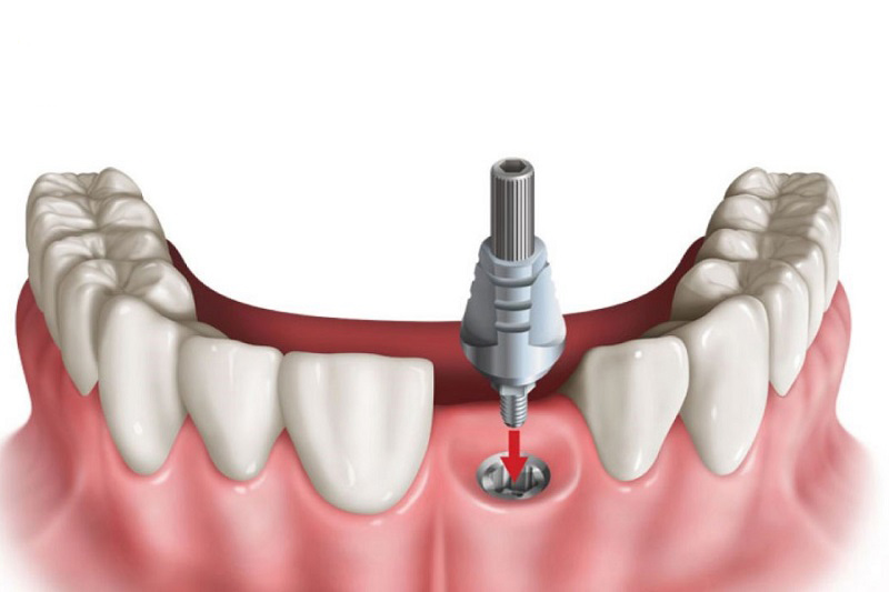 Trồng răng giả là việc thay thế chiếc răng thật của bạn bằng một chiếc răng giả thông qua phương pháp nha khoa