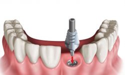 Trồng răng giả có đau không còn tùy thuộc vào từng phương pháp