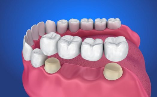 Trồng răng giả cố định có hai phương pháp là cấy ghép Implant và cầu răng sứ
