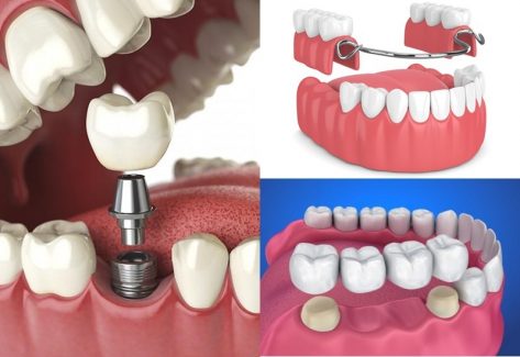 Thời gian trồng răng giả mất bao lâu còn phụ thuộc vào nhiều yếu tố