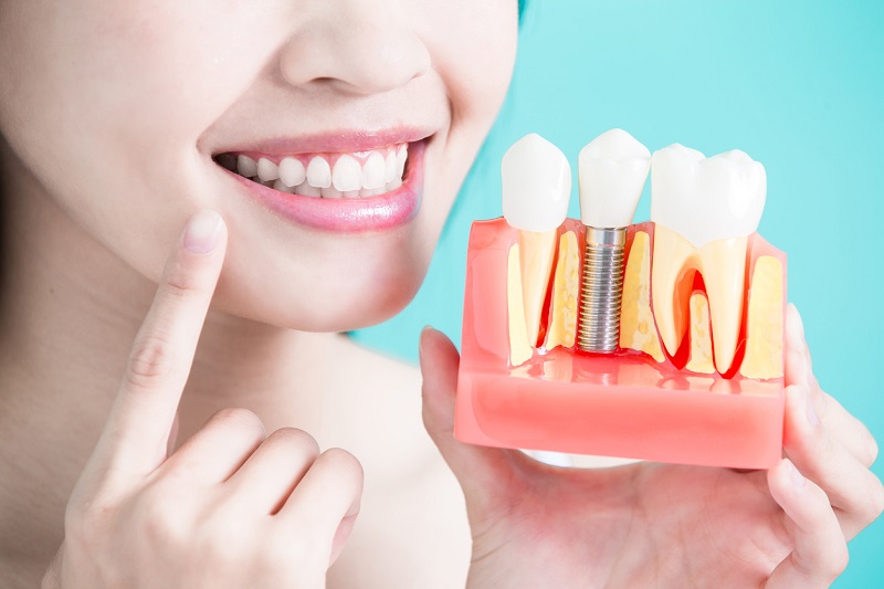 Cấy ghép implant giúp ngăn chặn được tình trạng tiêu xương hàm do mất răng
