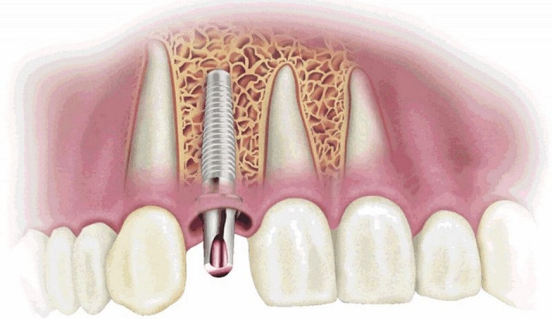 Đặt implant vào xương hàm được đánh giá là bước làm quan trọng nhất