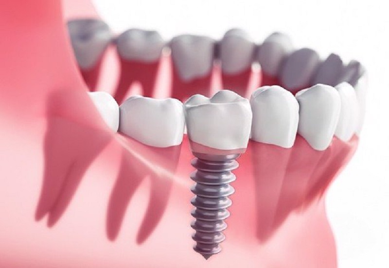 Chi phí cấy ghép implant phụ thuộc nhiều vào chất liệu trụ răng