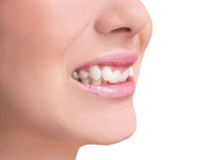 Trồng răng nanh bao nhiêu tiền là vấn đề được nhiều người quan tâm