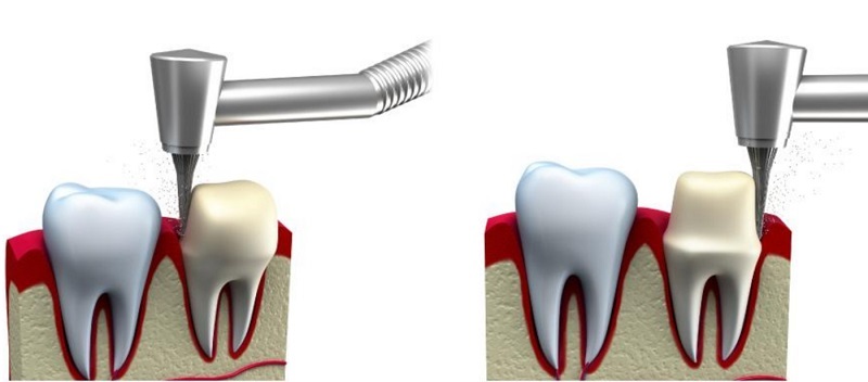 Trồng răng sứ có đau không quan trọng vẫn do tay nghề của bác sĩ thực hiện