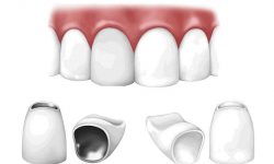 Trồng răng sứ loại nào tốt nhất? Răng sứ kim loại hay răng toàn sứ?