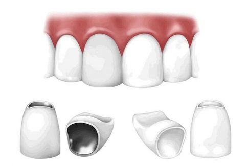 Trồng răng sứ loại nào tốt nhất? Răng sứ kim loại hay răng toàn sứ?