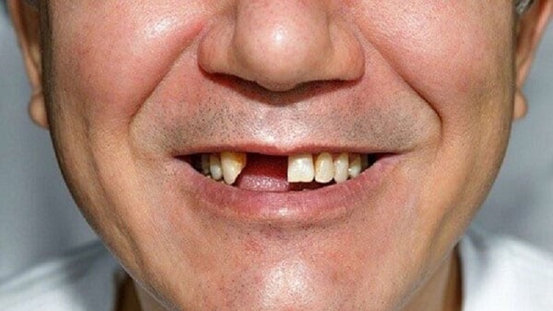 Trồng răng sứ được biết đến là phương pháp phục hình lại những chiếc răng đã mất